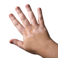 Hand with autoimmune disease