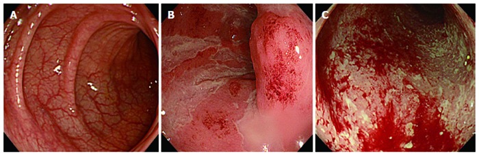 Gut inflammation in Irritable Bowel Disease