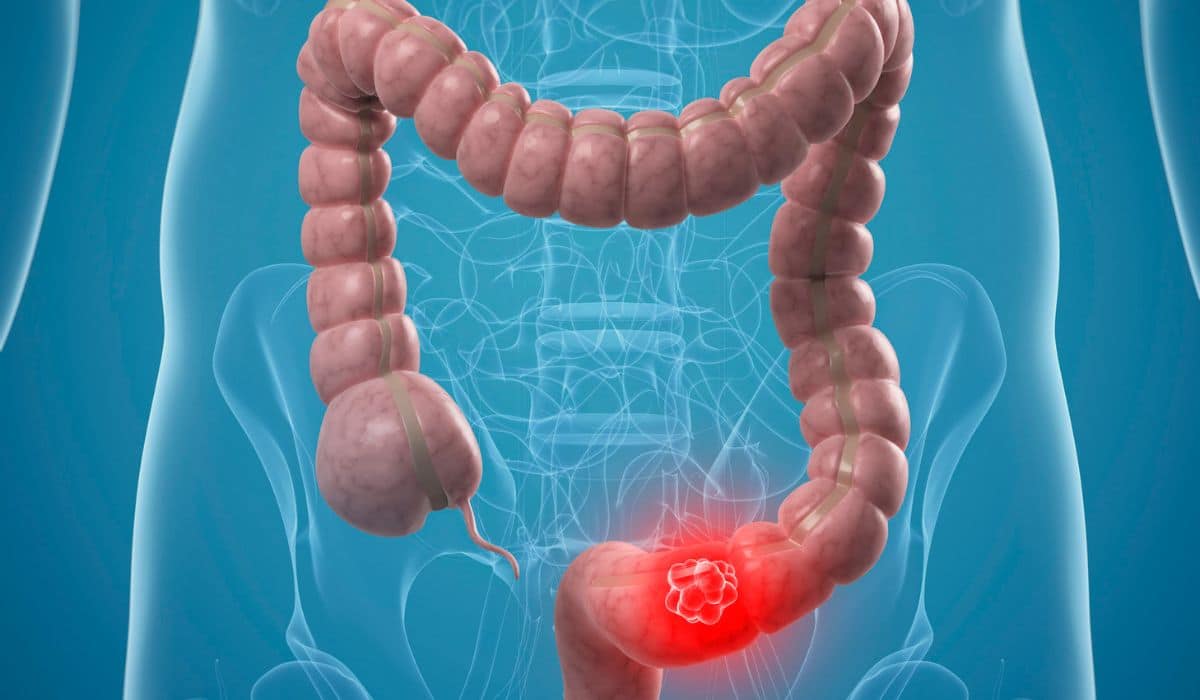 Colon Cancer