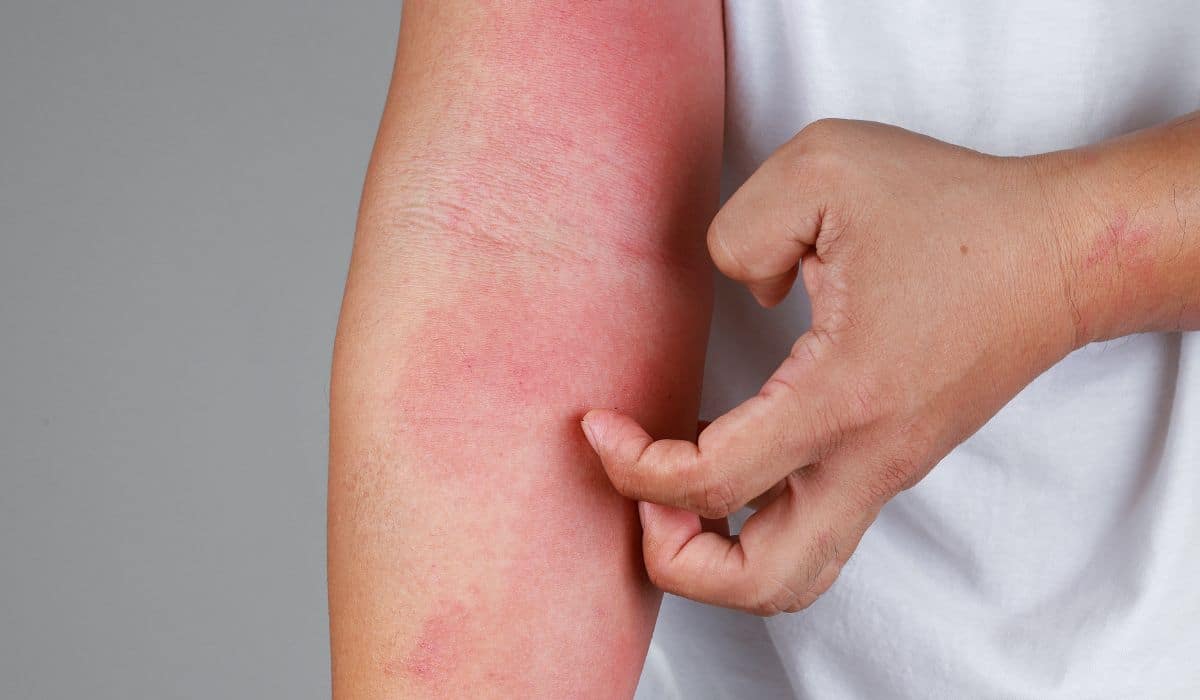 Allergy Rash 101, Understanding Skin Allergies